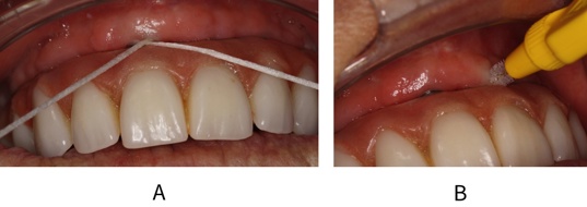 Implant-specific oral hygiene methods