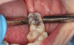 Assessment of tooth mobility using two rigid instrument handles