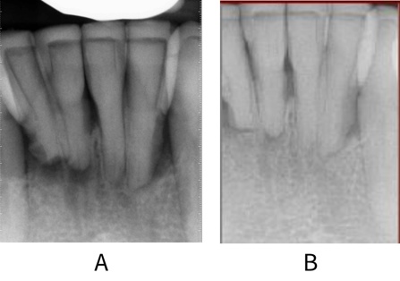 Peri-apical radiograph of a patient with periodontitis at baseline and at 5 years