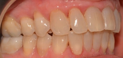 Gingival recession associated with toothbrushing trauma