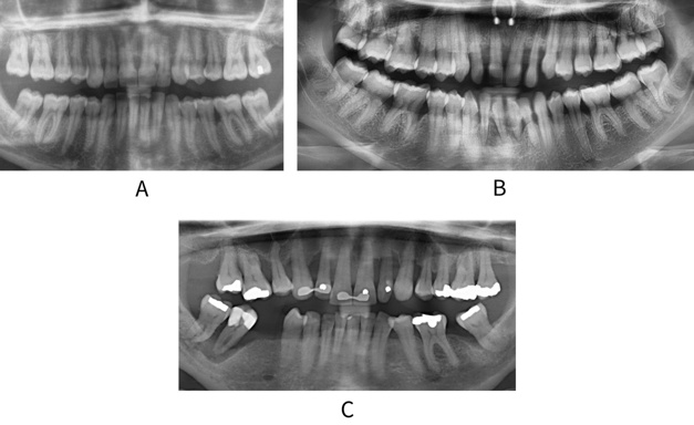Radiographs showing extent/distribution of disease