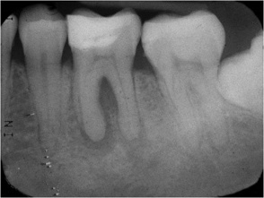 Radiograph showing an endodontic-periodontal lesion.