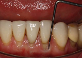Recession measured using a periodontal probe