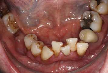 Crowded lower anterior teeth with supragingival calculus and staining.