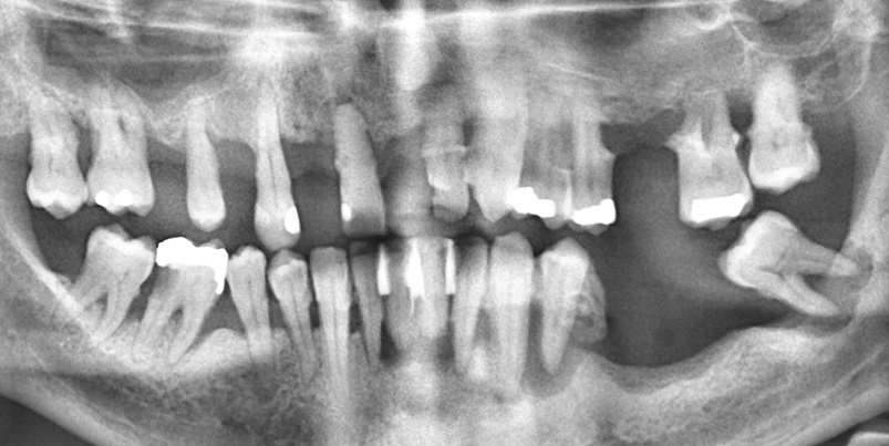 Radiograph of a patient with Stage IV periodontitis