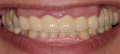 A patient with gingivitis