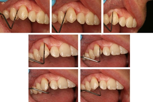 A PCP 12 probe being ‘walked’ around the gingival margin of the tooth.
