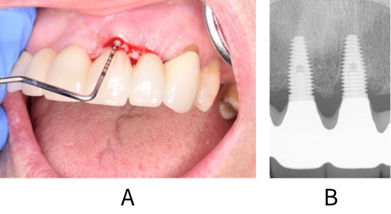 Clinical and radiographic images of a patient with peri-implantitis.