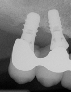Radiograph showing bone loss around dental implants