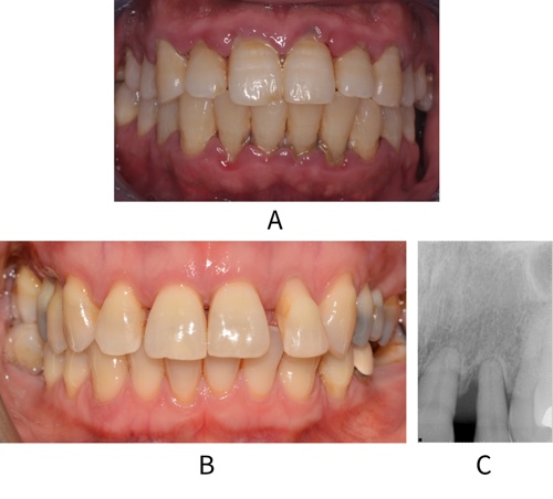 Patients with periodontitis
