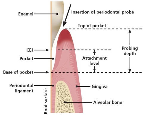 A simplified longitudinal section through a periodontal pocket