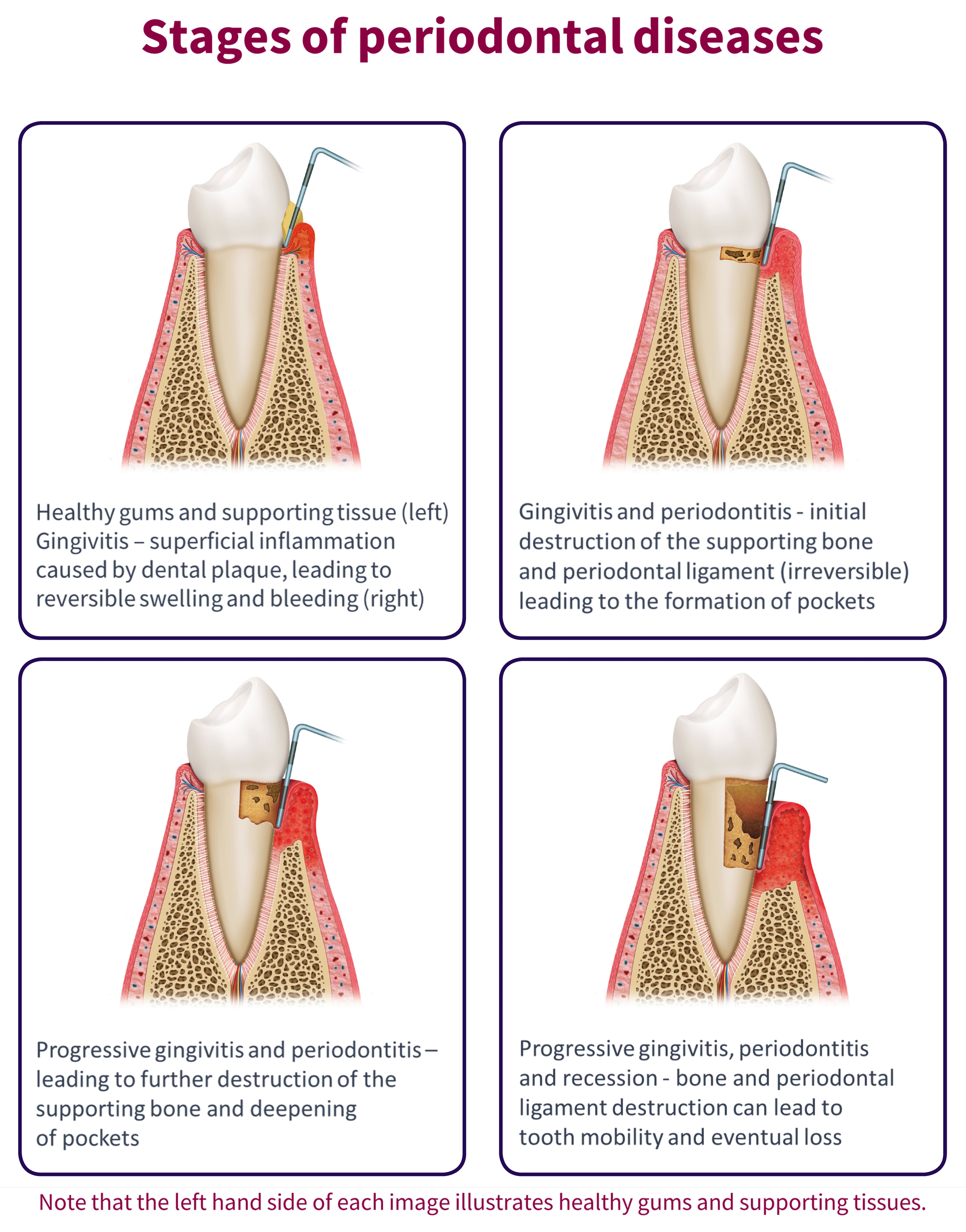 A visual aid for use in discussions with patients about oral hygiene
