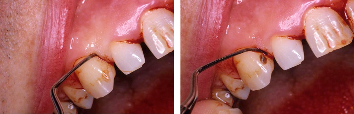 Removal of subgingival calculus using a curette
