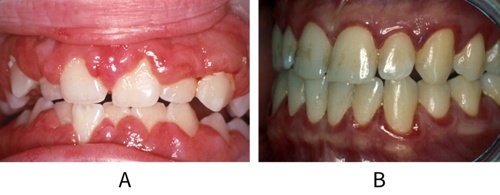 Images showing gingival enlargement and gingivitis in leukaemia patients and