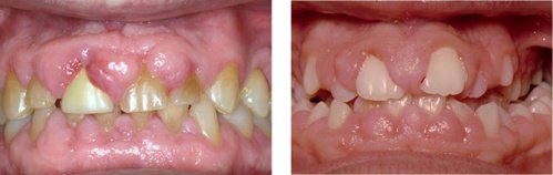 Examples of drug-influenced gingival enlargement