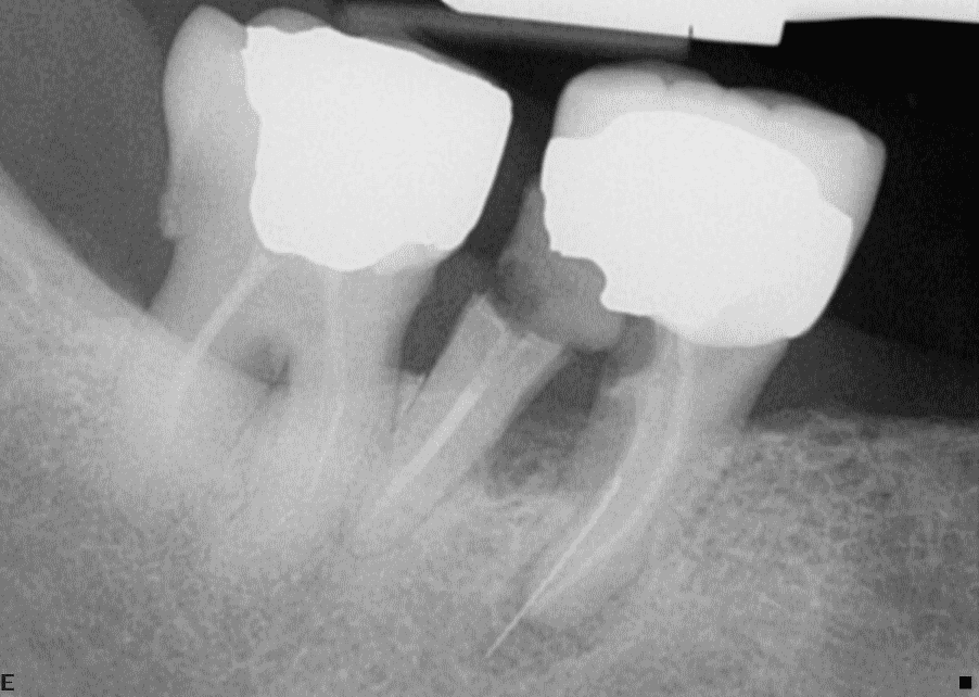 Radiograph showing two teeth with furcation involvement