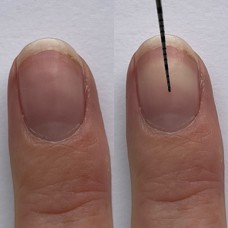 An unblanched fingernail and a fingernail blanched by a periodontal probe