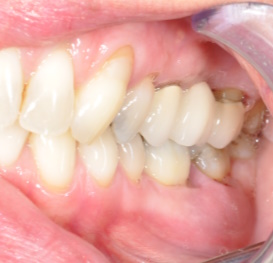 A periodontal abscess in a patient with periodontitis