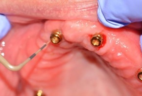 Probing around a dental implant.