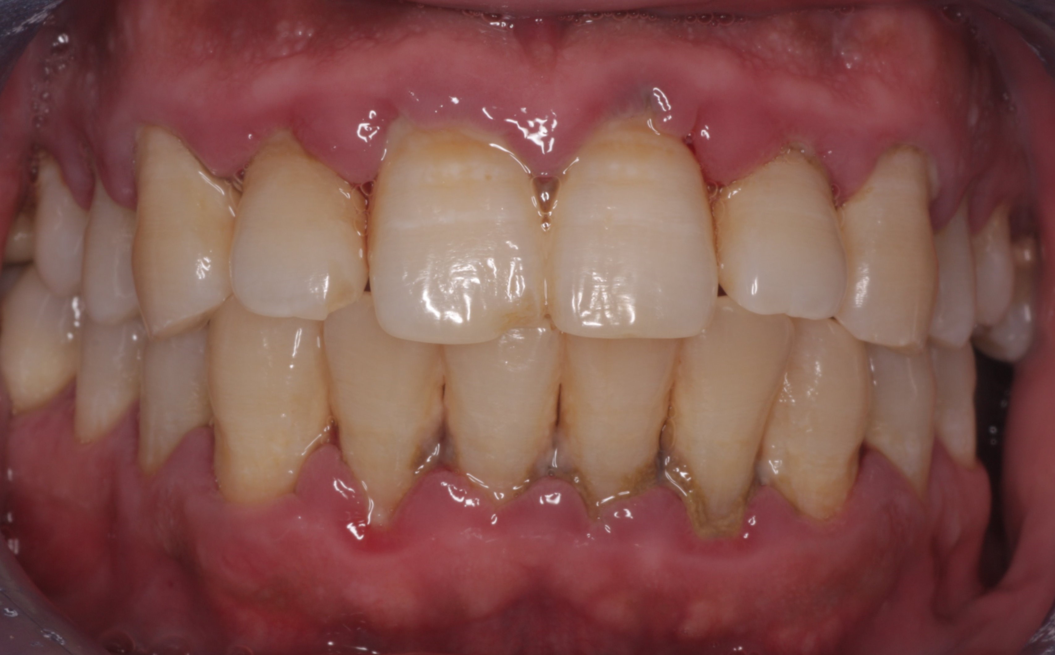 Periodontitis