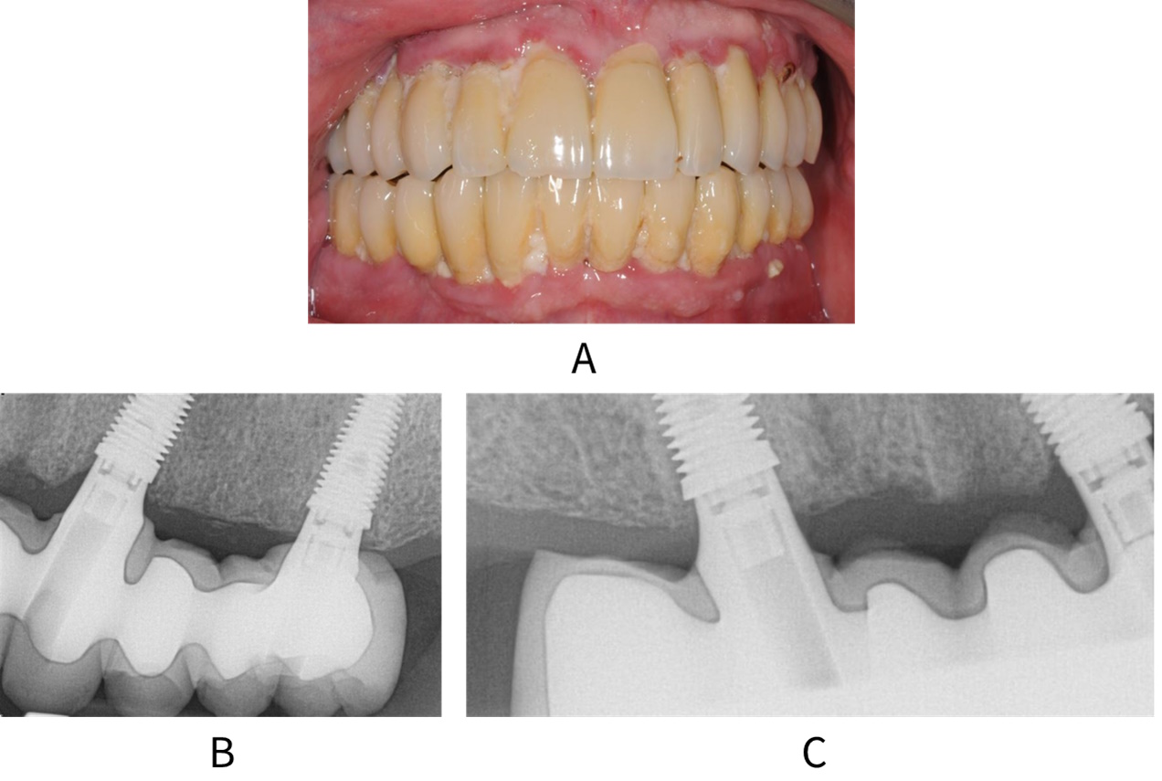 Clinical image and radiographs of a patient with peri-implant mucositis