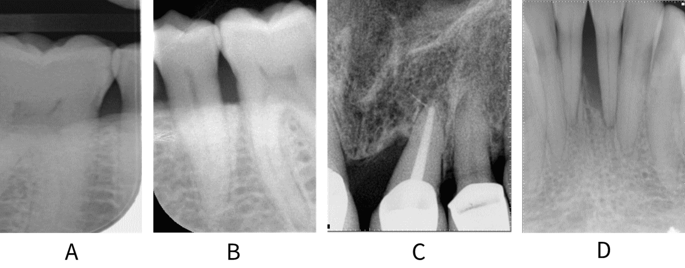 Radiographs showing Stage I-IV bone loss