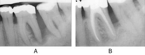 Peri-apical radiographs of endo-perio lesion before and after treatment